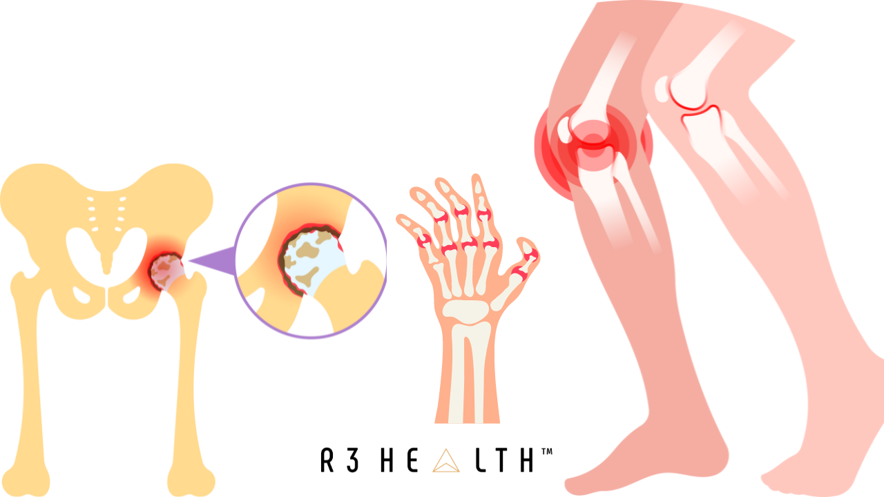 Osteoarthritis is inflammation and degeneration in the joints.